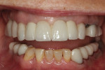 Fig 14. The correction of the occlusal plane can be seen in this postoperative photograph