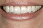 Figure 1  Preoperative view of the patient in natural smile.