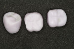 Fig 10. The milled crowns for the lower left.