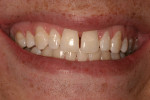 Fig 5. After the patient followed remineralization protocol, improvement in dentition appearance was evident.
