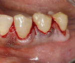 Fig 3. Intrasulcular incisions extending from the lateral incisor to the second premolar.