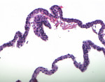 Fig 11. Photomicrograph depicting the cystic lining that was predominantly characterized by cuboidal to flattened squamous epithelium of one- to three-cell layers in thickness (20x magnification).