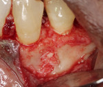Fig 8. The surgical site immediately following placement of freeze-dried bone allograft.