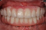 Fig 4. Intraoral view of conversion prostheses.