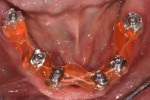 Fig 6. Mandibular implant-level implant impression with the open-tray splinted technique.