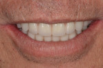 Fig 1. Initial smile.