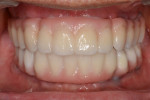 Fig 11. Frontal view of the definitive zirconia FDPs at 1-year follow-up.