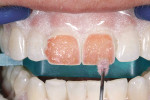 Figure 10  For maximum effectiveness, the whitening gel was stirred or agitated every 5 minutes on each tooth.
