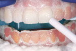 Figure 11  The whitening gel was removed from the teeth using suction only.