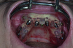 Fig 5. Maxillary implants placed through the surgical guide.