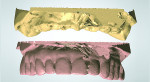Fig 9. Scan of immediate-load hybrid
prosthesis cast and master cast.