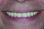 Fig 17. Patient’s smile with completed restoration.