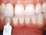 Figure 13  After the in-office power bleaching, the patient’s tooth shade was determined to be 0.5 M1, according to the Vita 3-D Master Shade Guide.