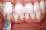 Figure 16  After 10 days of at-home bleaching, the patient’s teeth successfully lightened to a shade of 0.0 M.1.