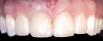 Figure 2  A healthy young woman has tooth No. 8 replaced with a dental implant. Note the esthetically pleasing restoration, gingival symmetry, position of the gingival zenith, and complete interproximal tissue fill.