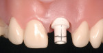 Figure 5  Before modifying the temporary abutment outside the mouth, it is marked intraorally to delineate its desired occlusal height, facial gingival zenith, and mid-facial position.