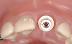 Figure 6  The interproximal contact points are marked as these will be responsible for supporting the interproximal gingival tissues and are critical in developing and supporting the papilla.