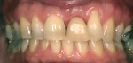 Figure 2  Before replacing the maxillary “flipper” with an implant-supported restoration, orthodontic therapy and root coverage were undertaken to align teeth, properly distribute spaces, and obtain a more proper tooth size.