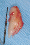 Figure 3  A 15-mm wide, 2-mm thick connective tissue graft was harvested from the palate and partially de-epithelialized.