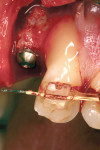 Figure 4  The maxillary left lateral incisor was treated with enamel matrix derivative during surgery to improve the ability for true regeneration over the denuded root surface.