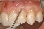 Figure 9  Enamel matrix derivative therapy after root debridement and surface treatment with EDTA.