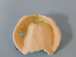 Border molding was done at the time of the initial impression by utilizing a two-part impression of heavy-body polyvinyl first, followed by a wash of a light-body polyvinyl and performing normal muscle movements to ascertain flange length.