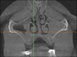 A coronal CBCT section at the level of the maxillary sinuses shows extensive presence of inflammatory tissues in the right and left maxillary sinus (more so on the left one). A small portion only of the right sinus shows
presence of air. This appearance is consistent with sinusitis.