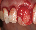 Figure 11  Insertion of the amnion/ chorion graft before suturing after it has absorbed heme from the surgical site.