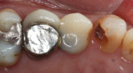 The patient presented with was a large composite filling that had fallen off tooth No. 11
with recurrent decay.