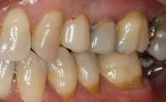 There was recurrent decay under the abutment of tooth No. 13 and the patient was not very happy with the esthetics of the acrylic-fused-to-metal bridge that was done more than 20 years ago.