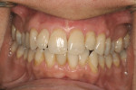 Figure 13  Three month follow-up after surgical correction of recession defects on maxillary right anterior teeth showing excellent root coverage and tissue tone.