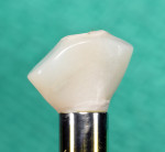 Fig 1. Screw-retained provisional restoration fabricated using acrylic filled with autopolymerizing resin and a polyether-ether-ketone polymer abutment.