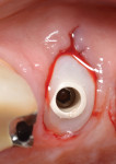 Fig 2. Provisional restoration placed at the time of post-extraction immediate implant placement.