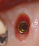 Fig 4. Peri-implant sulcus bleeding at the first disconnection of the provisional restoration 5 months after implant placement.