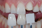 Fig 1. Image showing correct relationship of shade tabs to evaluated tooth. They need to be in the same vertical plane as the tooth evaluated.