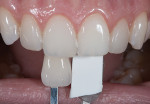 Fig 3. This is the same shade tab as shown in Figure 2 except here the tab was placed approximately 3 mm behind the tooth. Note the difference in perception of color.