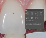 Fig 14. Measuring the “S,” or saturation of the tooth and shade guide.