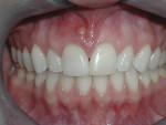 Fig 1. Tooth No. 8 pretreatment; note the fistula in the attached gingiva.