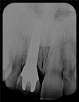 Fig 6. Periapical x-ray of implant.