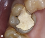 Fig 1. The tooth to be treated.