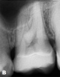 Fig 15. The x-ray after bonding.