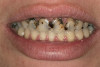 Fig 18. Central incisors: cross-polarization.