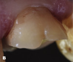 Fig 10. Vestibular view of preparation in mouth.