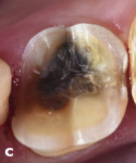 Fig 8. Cusp reduction in the mouth.