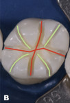 Fig 4. The mesiodistal and buccolingual guide grooves are shown in orange, the cusp grooves in green.