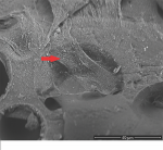 Fig 8. Fibroblast-like cells with immunogold labeling (arrow) on the surface of the provisional restoration under backscattered microscope (Figure 8), and the corresponding area under SEM (Figure 9).