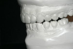 Figure 5  Approximately 80% of the entire case is completed before tooth preparation.