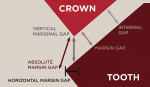 Figure 2  Schematic of an underextended crown.