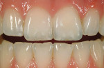 Figure 2  Postoperative view of the same case restored with a bonded veneer fabricated from a powder/liquid veneer made from a two-phase glass VM7 (Vita/Vident).