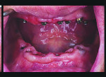 Fig 9. A fixture-level impression is taken of the intraoral situation.